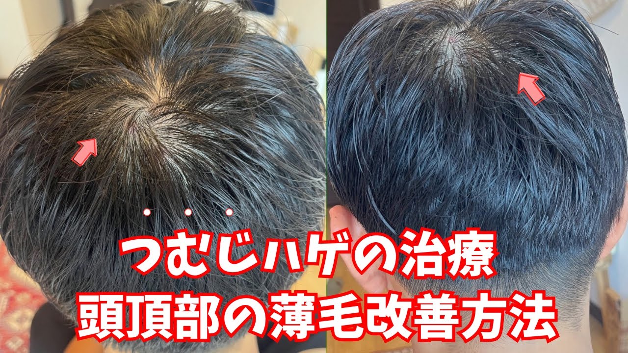 頭頂部の薄毛を本気で改善させる方法とは？【つむじハゲ・てっぺんハゲ】