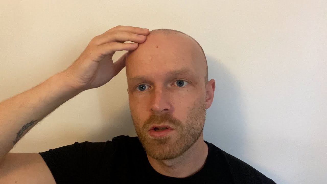 I Never Thought I'd Get Any Girls After Going Bald...
