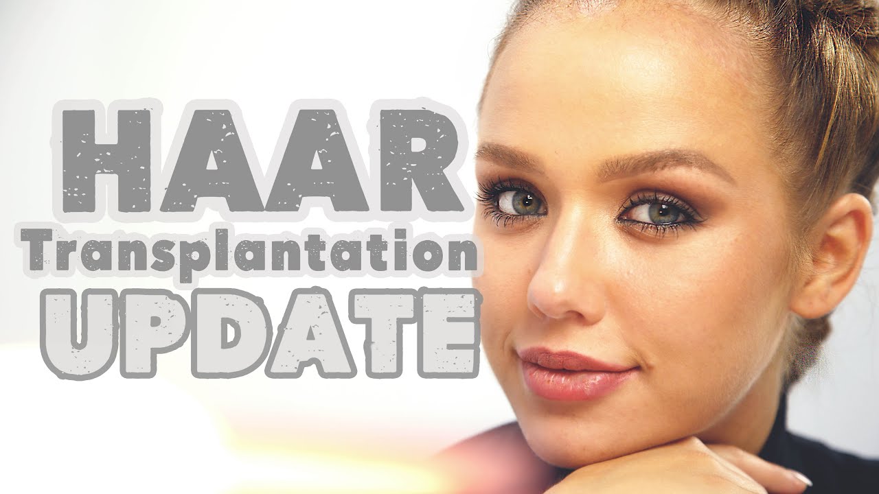 HAARTRANSPLANTATION UPDATE | KIM GLOSS