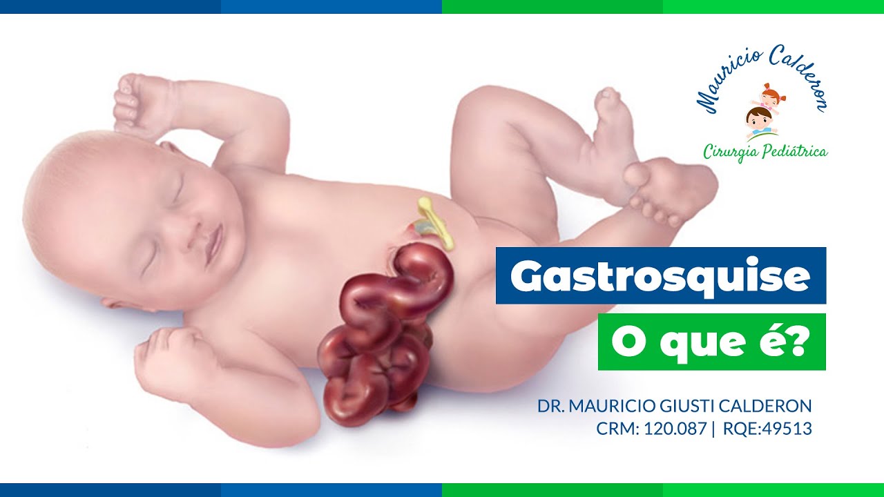 Cirurgia Infantil Channel | O que é GASTROSQUISE?