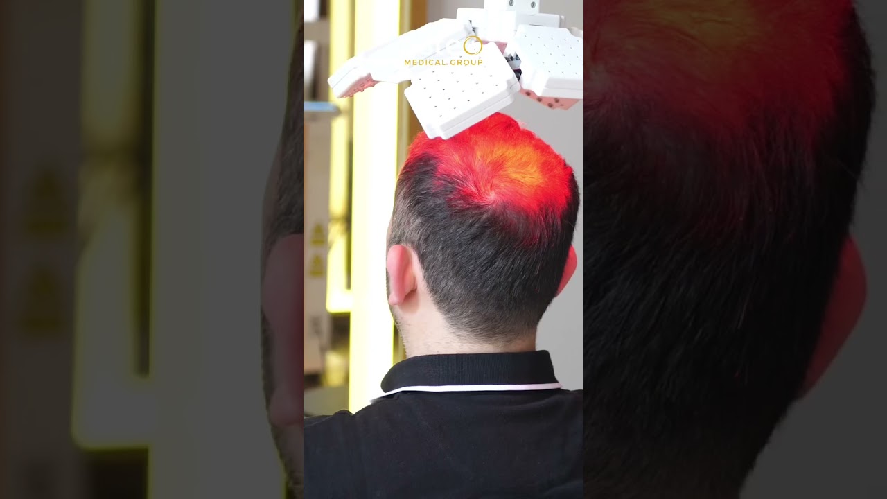 Sa&ccedil; lazer tedavisi #estemedicalgroup #hairtransplant #hairlaser #hairlasertherapy #prp #sa&ccedil;ekim