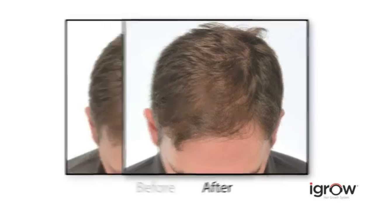 iGrow&reg; Hair Rejuvenation System