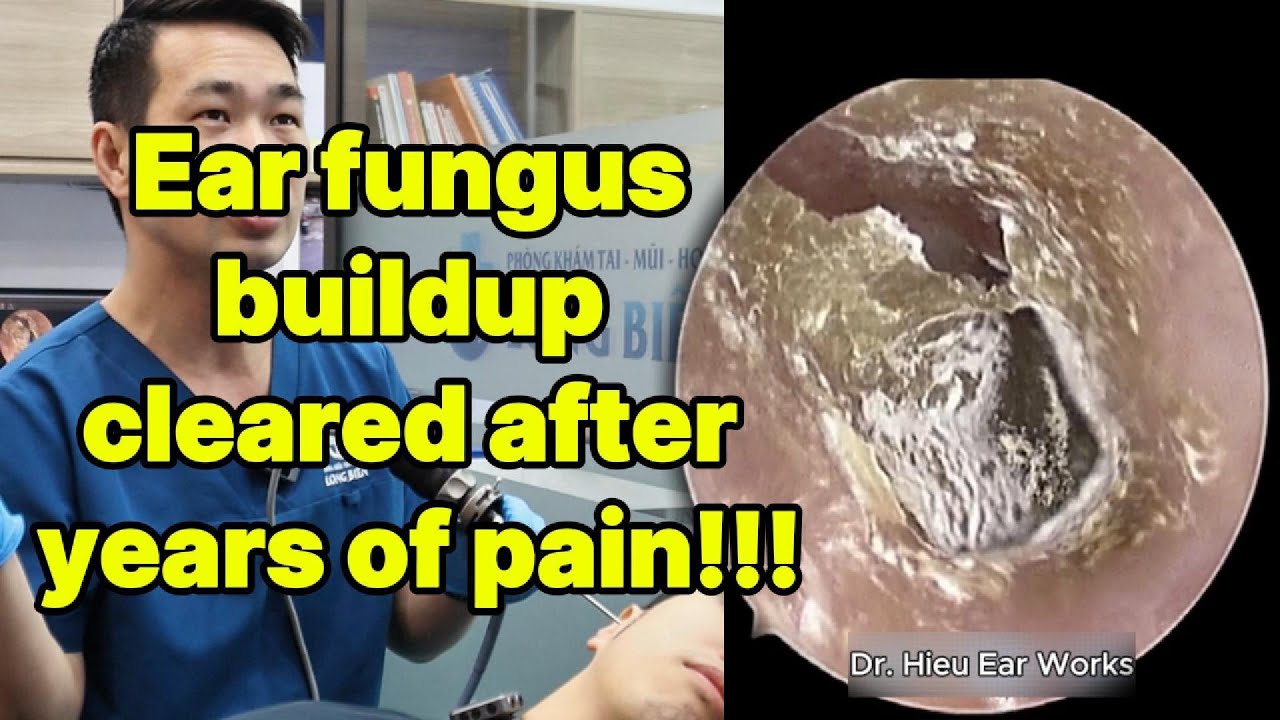 Ear fungus buildup cleared after years of pain | ear cleaning | ASMR earwax | soothing |relax|