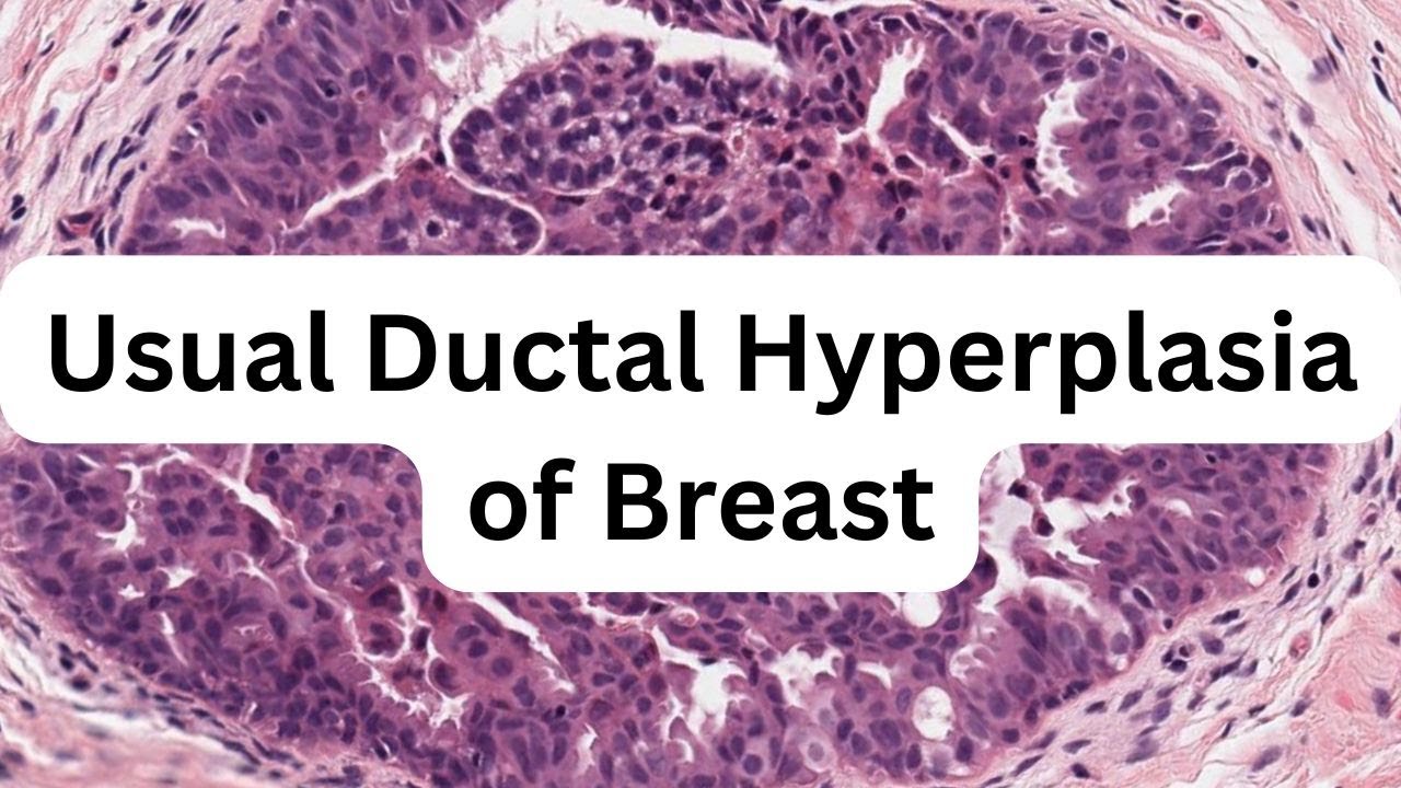 Usual Ductal Hyperplasia of Breast