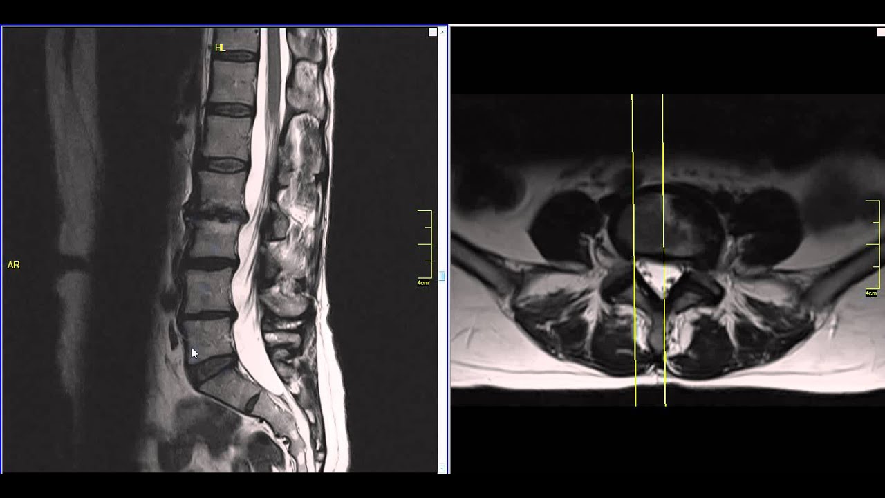 Far Lateral Lumbar Disc Herniation MRI Explained | Dr. Jeffrey P. Johnson | HD