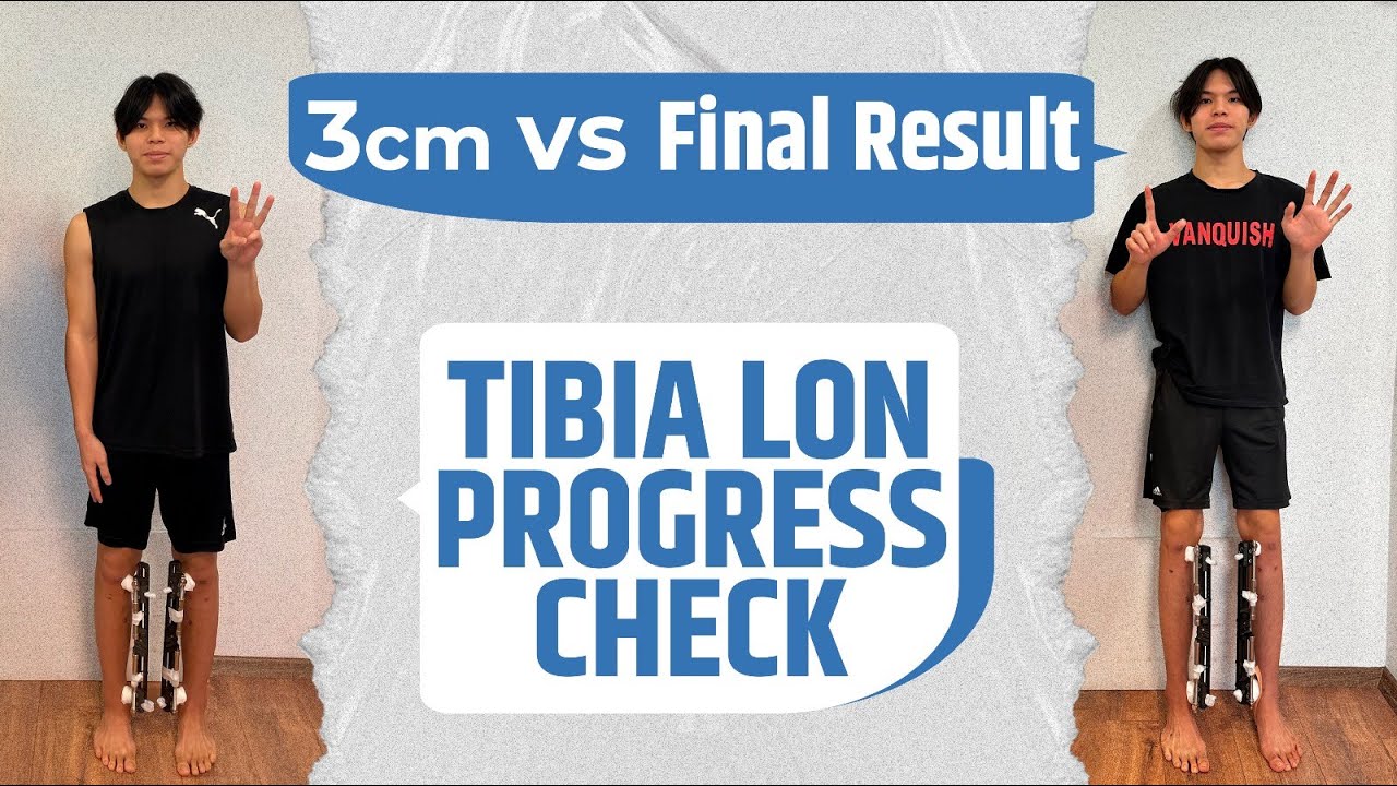HALFWAY & FINISH LINE: PATIENT TALKS TIBIA LENGTHENING PROGRESS WITH PHYSIOTHERAPIST