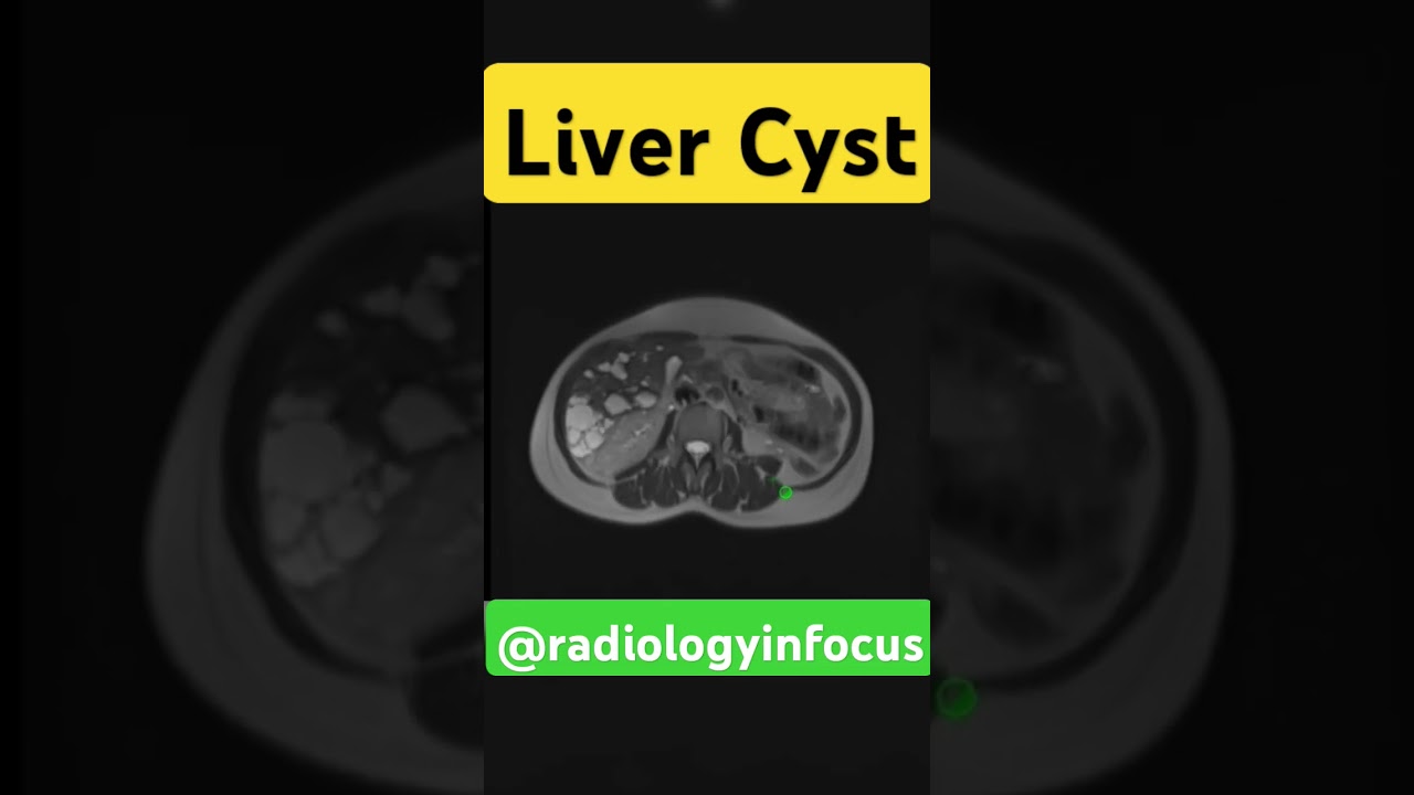 Liver Cyst| MRI 