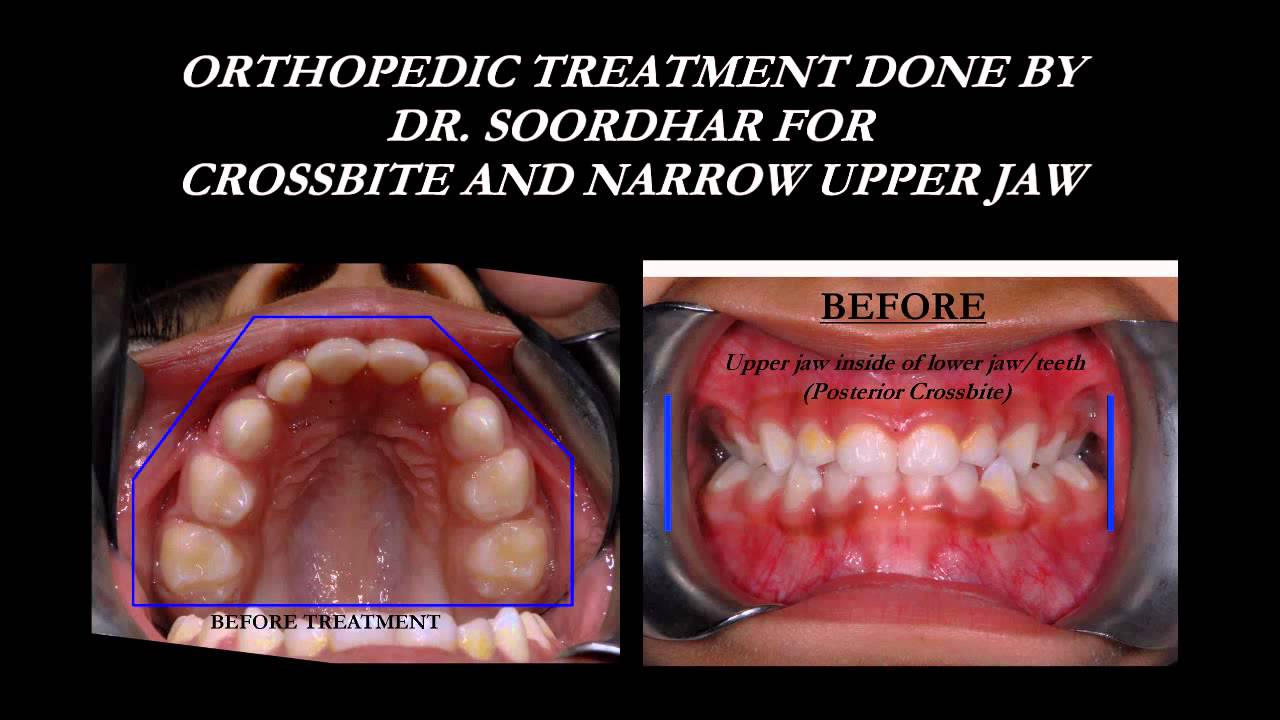 Non-Extraction Braces & Functional Jaw Orthopedics (FJO,ALF,Palatal Expander,Facemask,Bioblock)