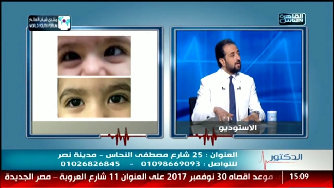 الدكتور | علاج الحول وكسل العين مع د.نرمين البدوى