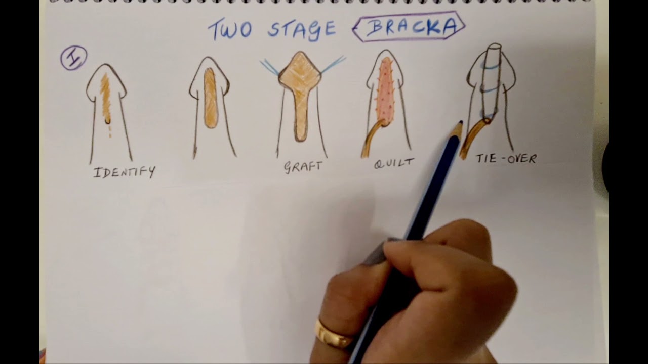 Hypospadias - 2 stage Bracka
