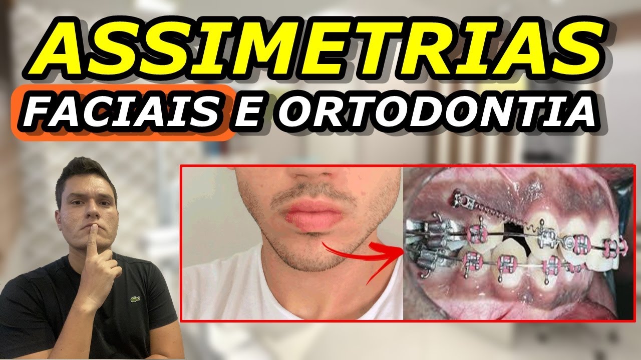 ASSIMETRIAS FACIAIS | DÁ PRA CORRIGIR ROSTO TORTO COM APARELHO ORTODÔNTICO?