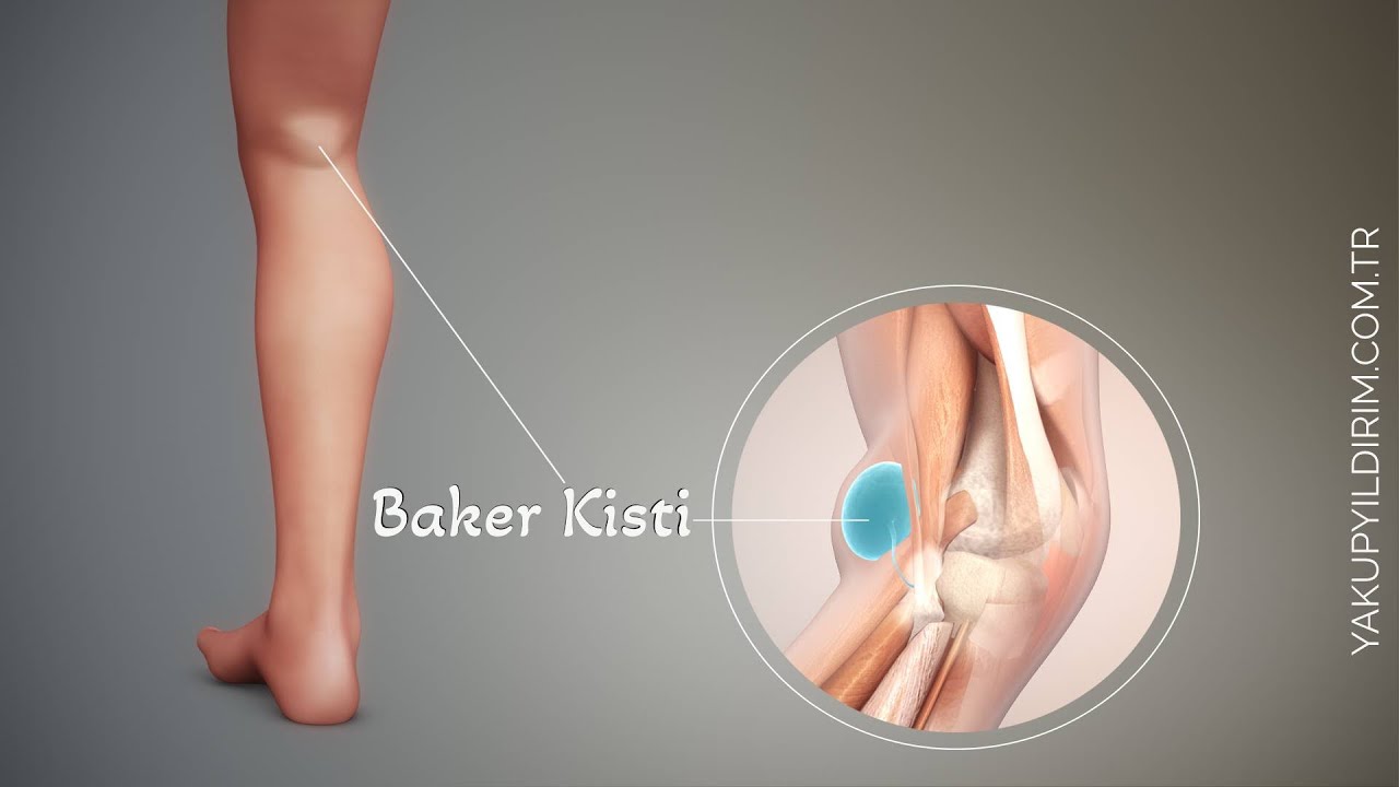 Baker Kisti: Belirtileri, Nedenleri ve Tedavi Yöntemleri | Prof. Dr. Yakup YILDIRIM
