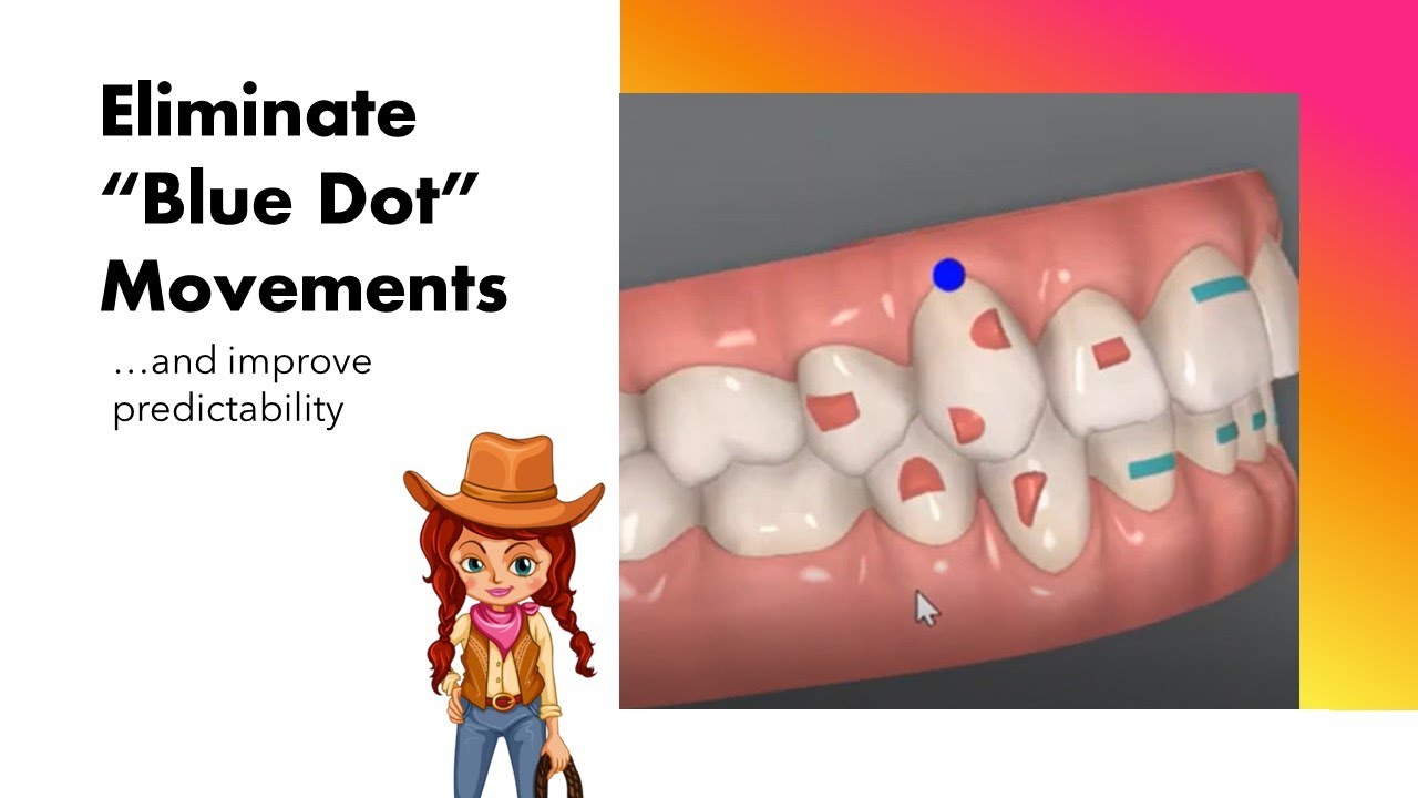 Invisalign ClinCheck - Eliminate 