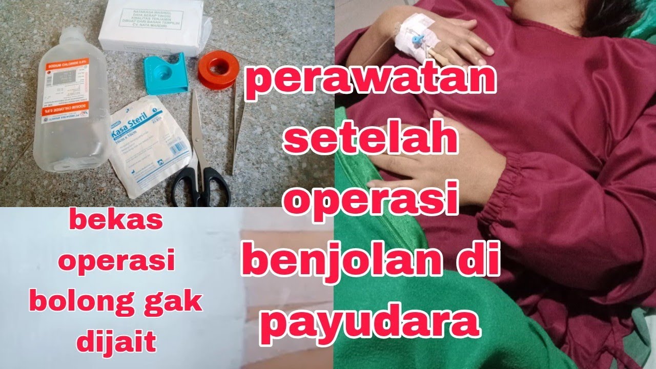 Wanita wajib tau,penting ‼️perawatan setelah operasi benjolan payudara‼️bekas operasi bolong