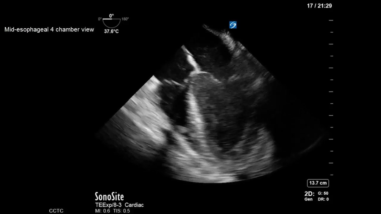 Transesophageal Echocardiography: Management of ECMO