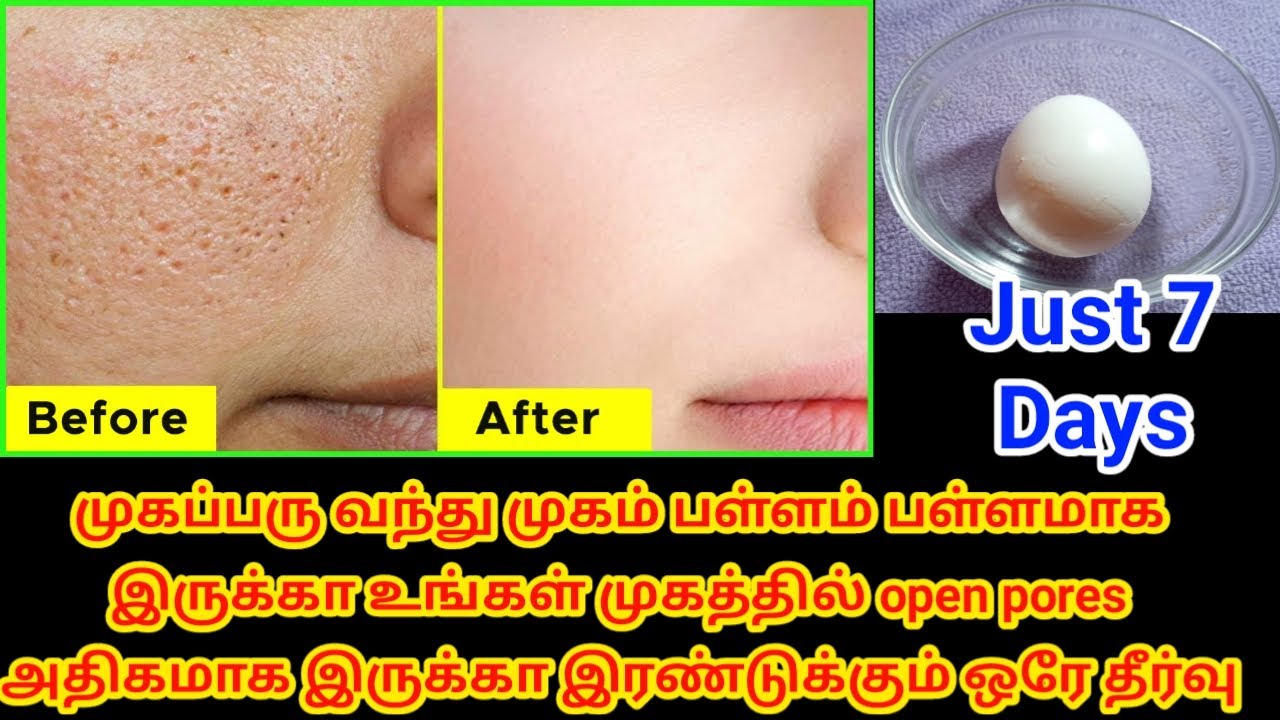 How to get rid of open pores at home in tamil/ முகத்தில் உள்ள பள்ளம் நீங்க இதை செய்யுங்கள்