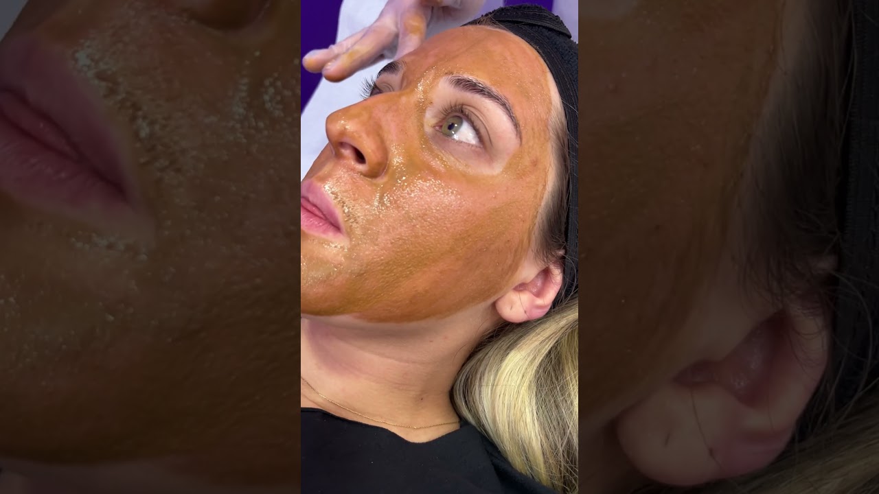 Peeling Qu&iacute;mico
