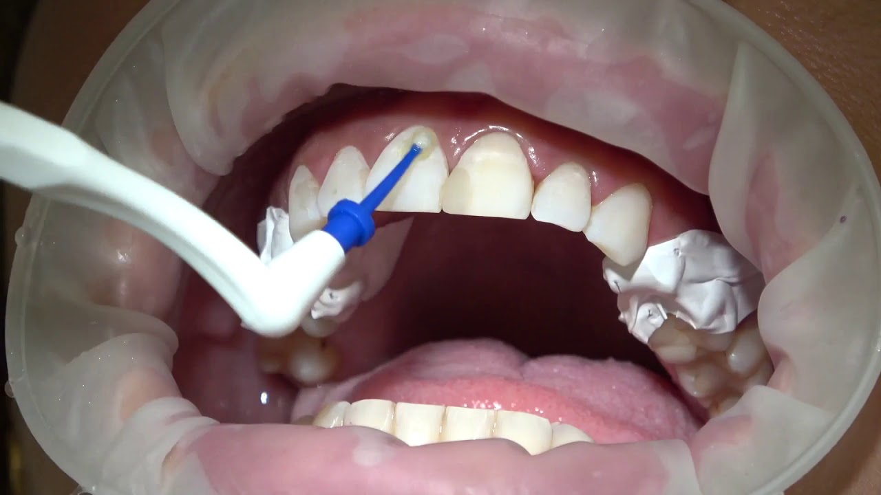 Veneers ohne Schleifen - Nonprepveneers