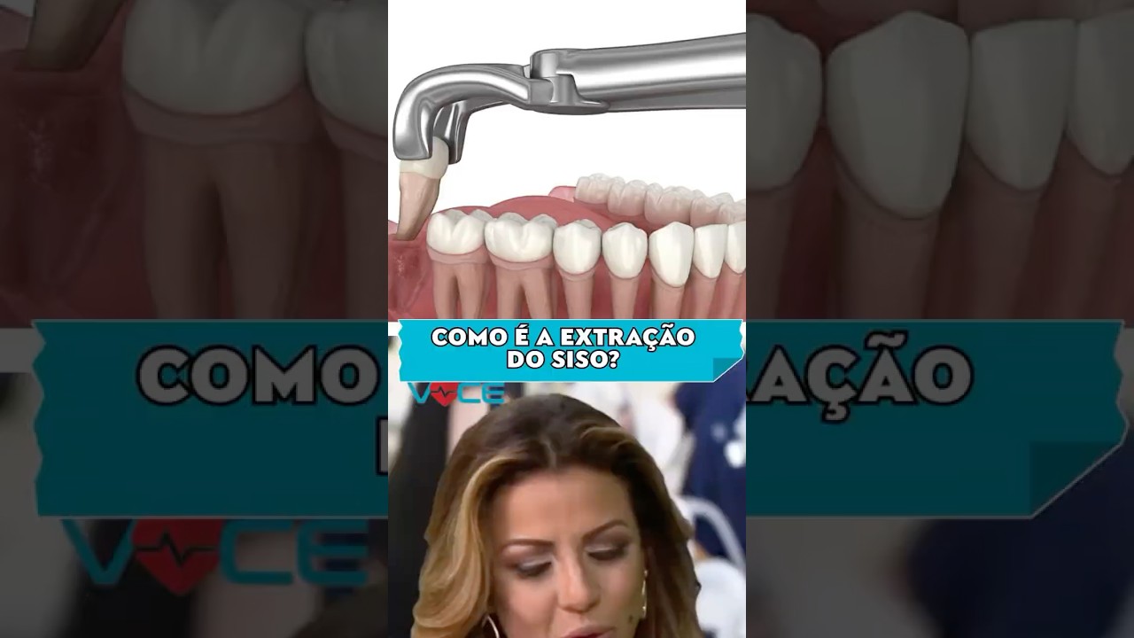 COMO É A EXTRAÇÃO DO SISO?
