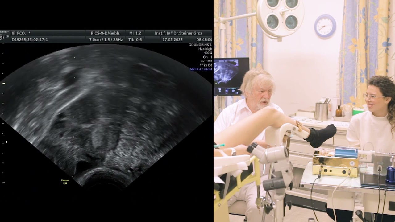 Steiner 3-9-11 PCO, OHSS free IVF. OPU procedure.