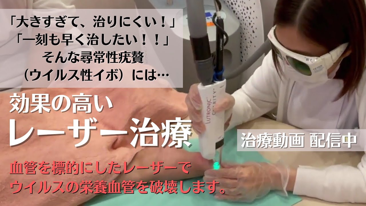 ウイルス性イボのレーザー治療とは？実際の治療映像で紹介