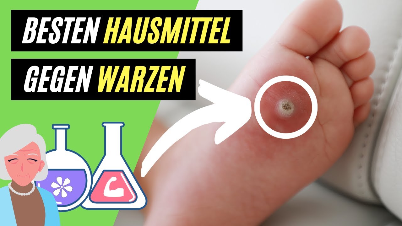 ✅ Warzen entfernen mit Hausmitteln - 5 hilfreiche TIPPS gegen Warzen!