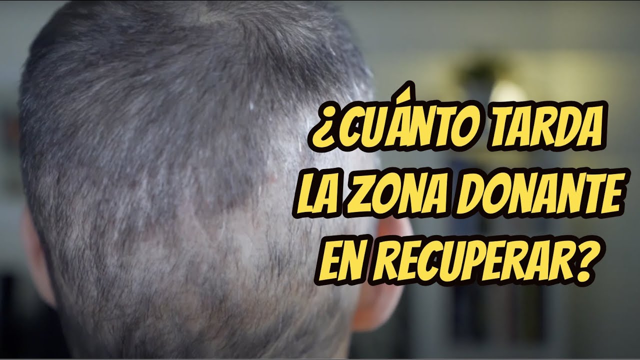 Trasplante capilar en España, día 70, ¿Se va a recuperar mi zona donante?