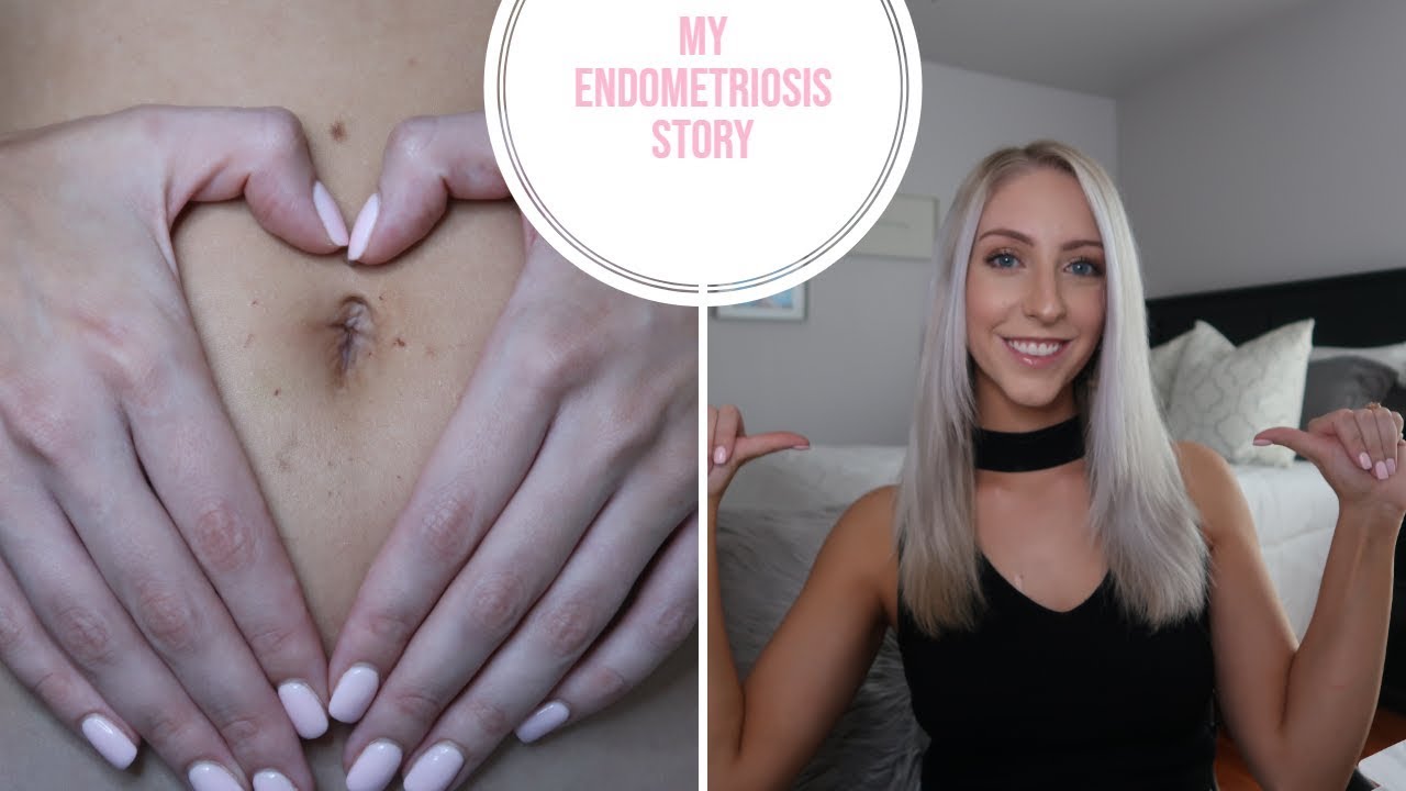 MY ENDOMETRIOSIS STORY | LAPAROSCOPIC SURGERY EXPERIENCE & TWO 10 CM CYSTS