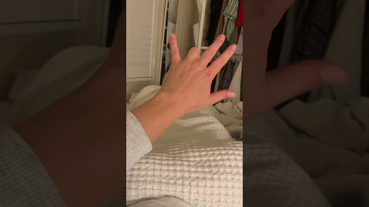Left ring finger amputation 1 year later