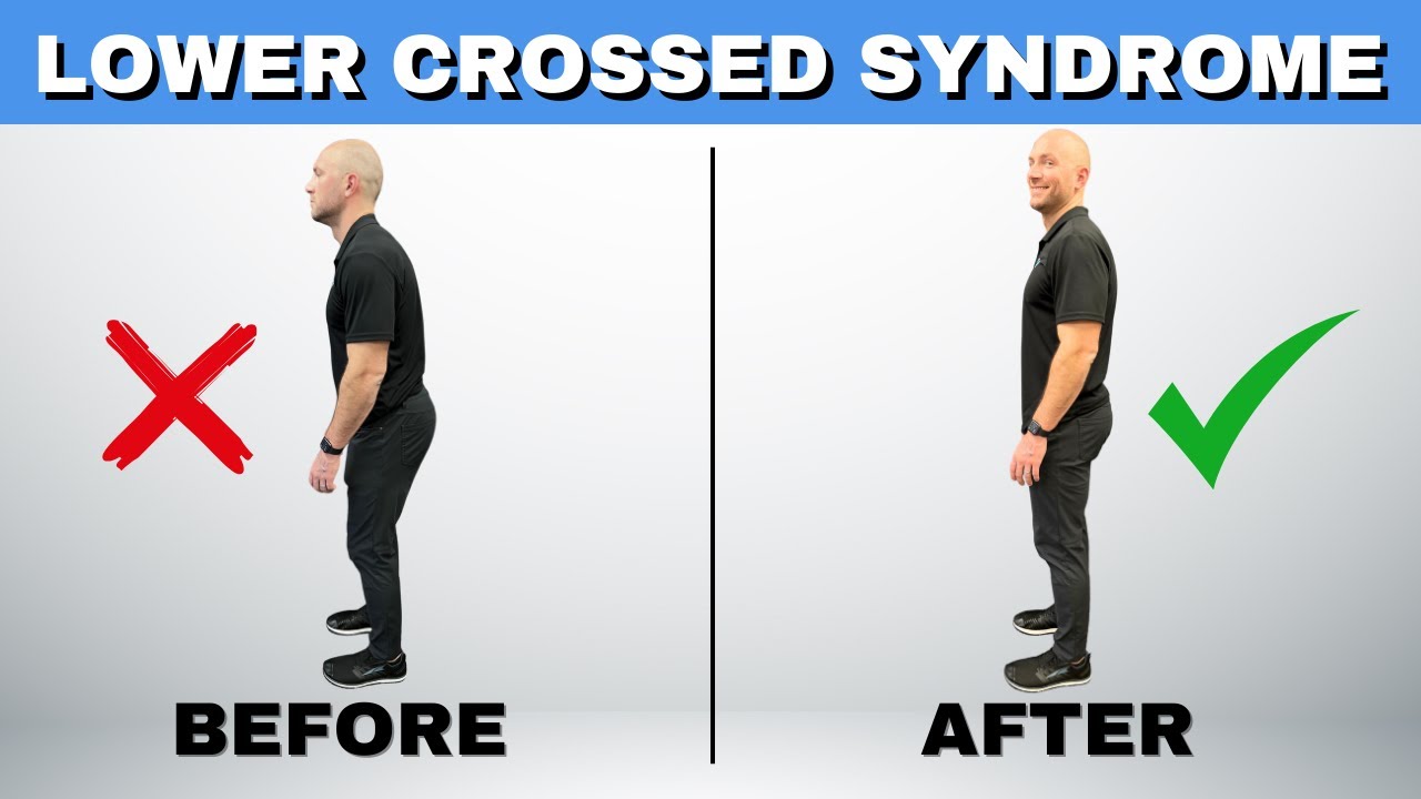 What are 5 Main Symptoms of Lower Crossed Syndrome and a Clear Fix!