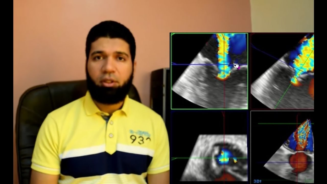 How to measure the 3D-Vena Contracta Area (3D-VCA) for mitral regurgitation