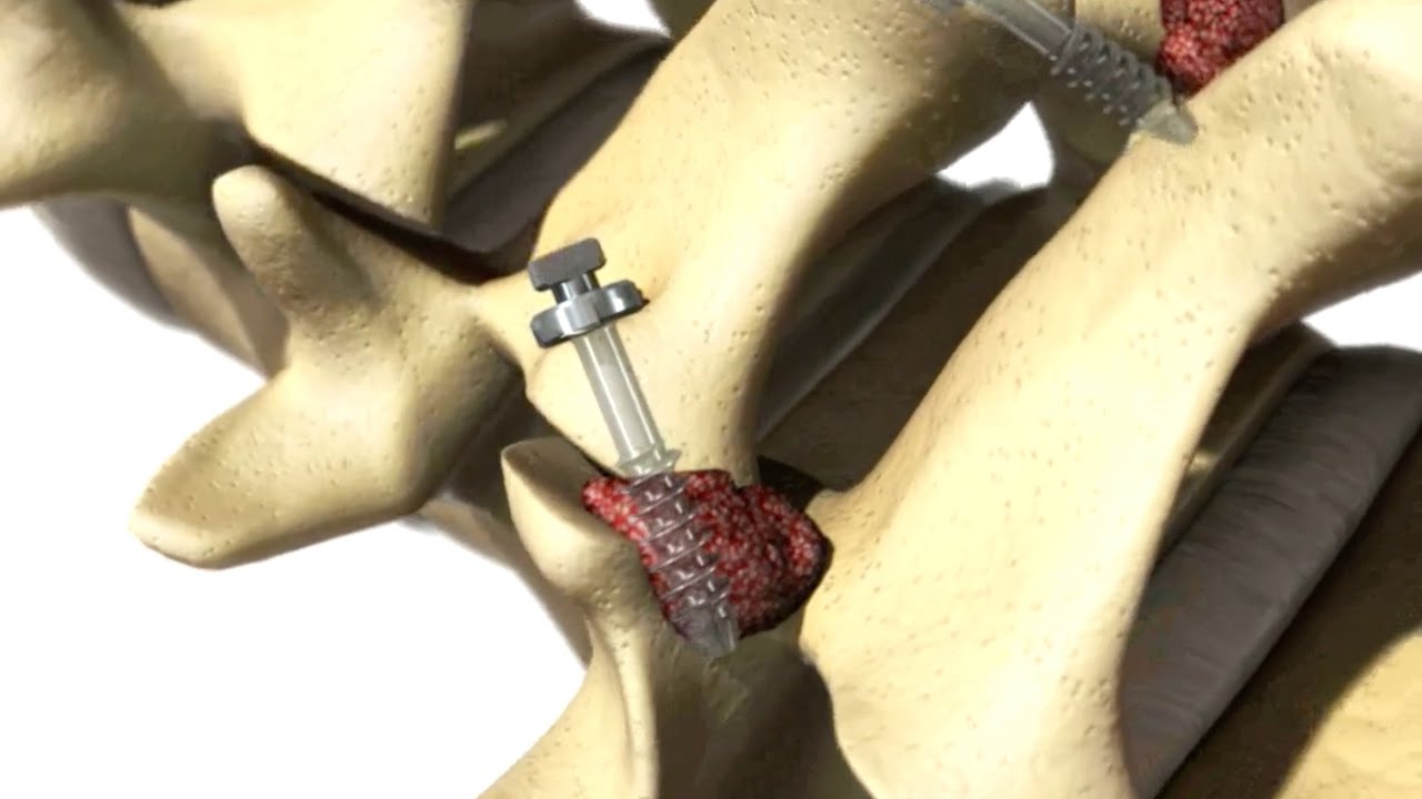 Capture&trade; Facet Fixation System