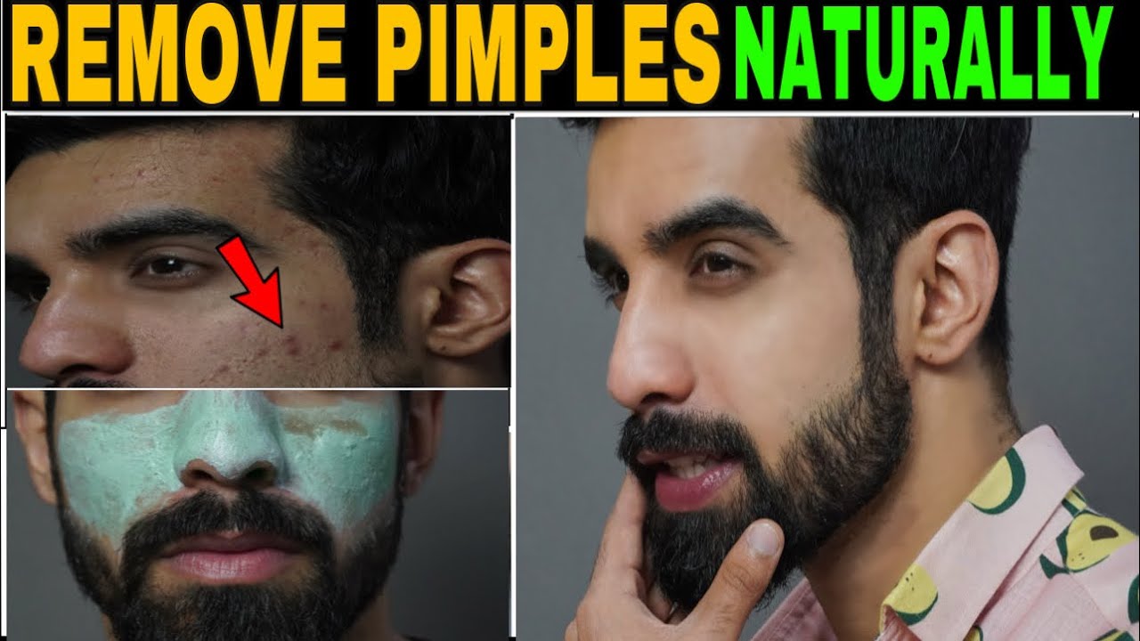 पिंपल को प्राकृतिक तरीके से जल्दी कैसे हटाएं? *वास्तविकता* | मुंहासे का इलाज | TheFormalEdit | हिंदी