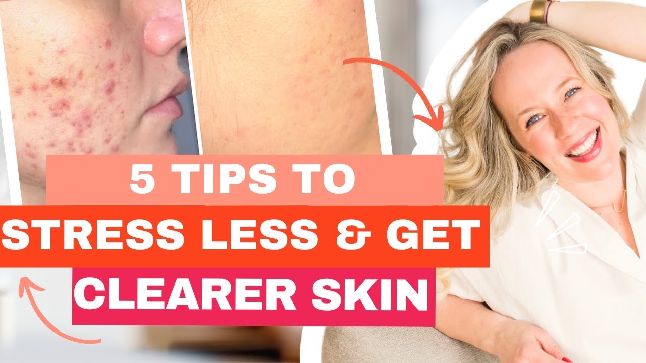 Stress and acne - 5 TIPS FOR STRESS MANAGEMENT FOR CLEARER SKIN