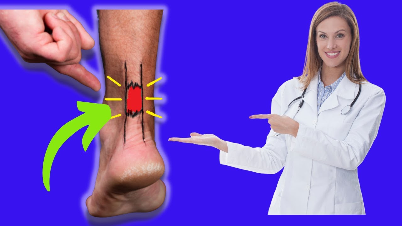 How to Tell if You've TORN Your Achilles Tendon!