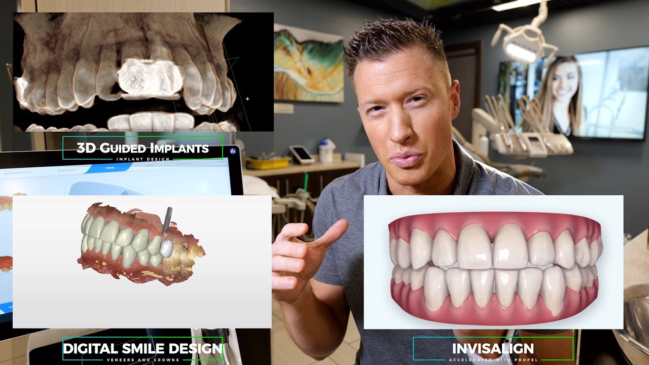 Invisalign, Implant, Full Mouth Smile Makeover with Crowns and Veneers