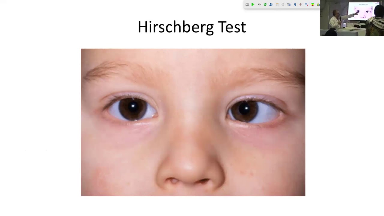 Lecture: Esotropia-Exotropia: Dr. Carlos Solarte