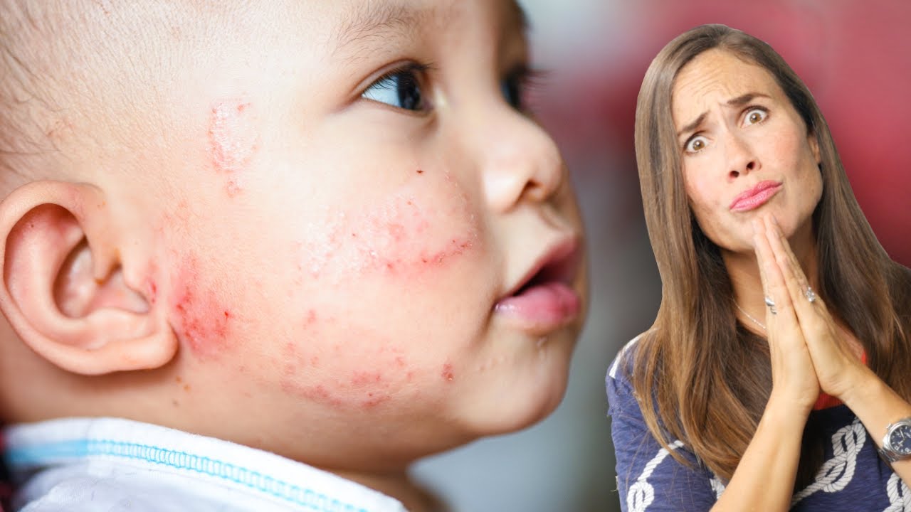 Baby Eczema: What Does it Look Like? AND How to Treat it NATURALLY! (PICTURES)