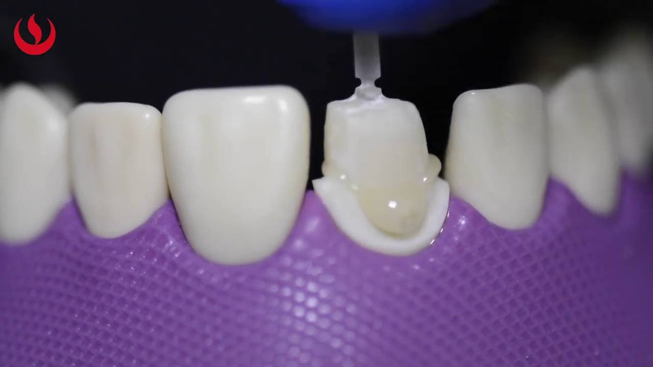 Espigo preformado anatomizado con resina