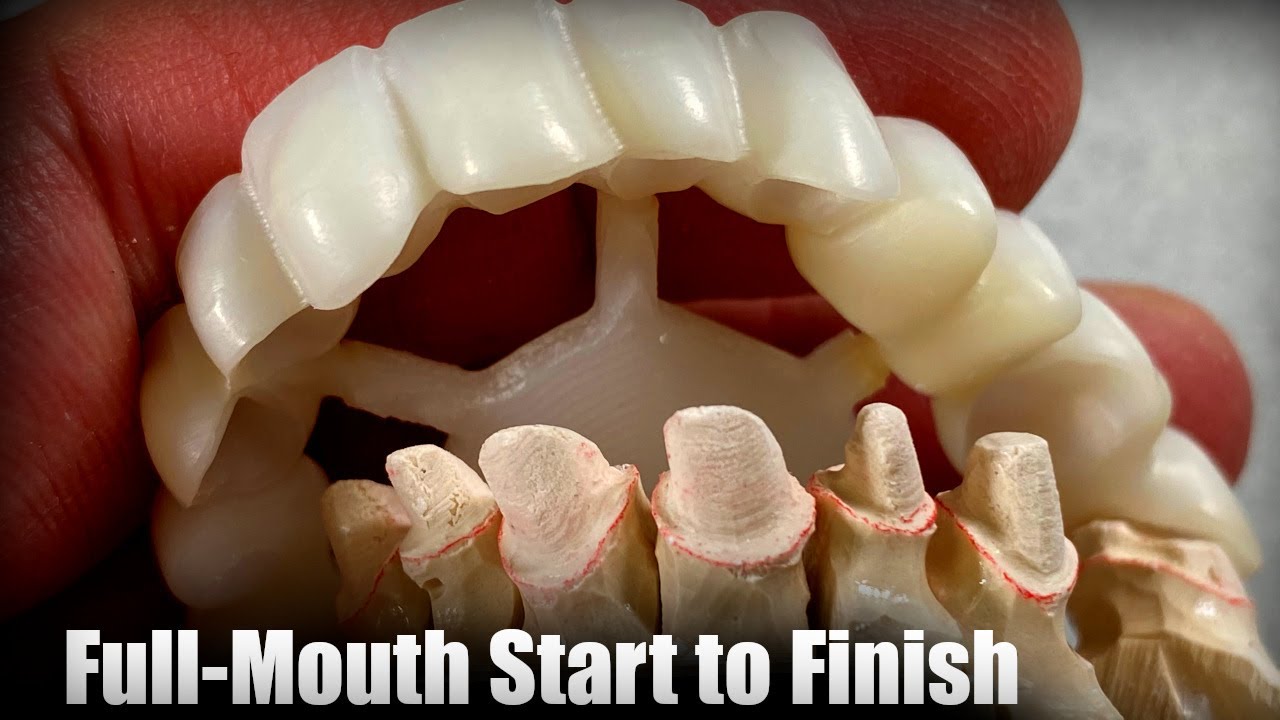 Full-Mouth Restoration Start to Finish
