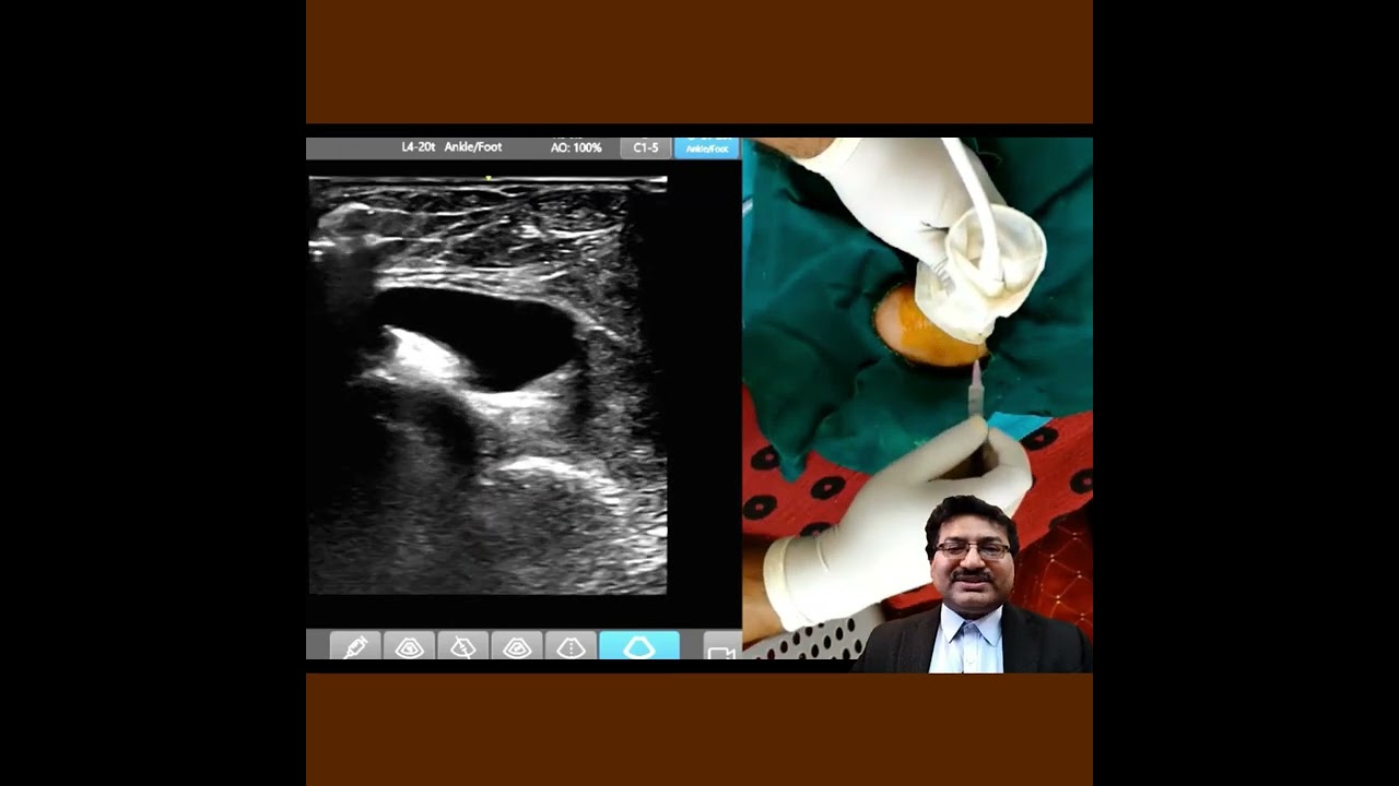 Retrocalcaneal Bursitis USG Guided aspiration | Dr Debjyoti Dutta