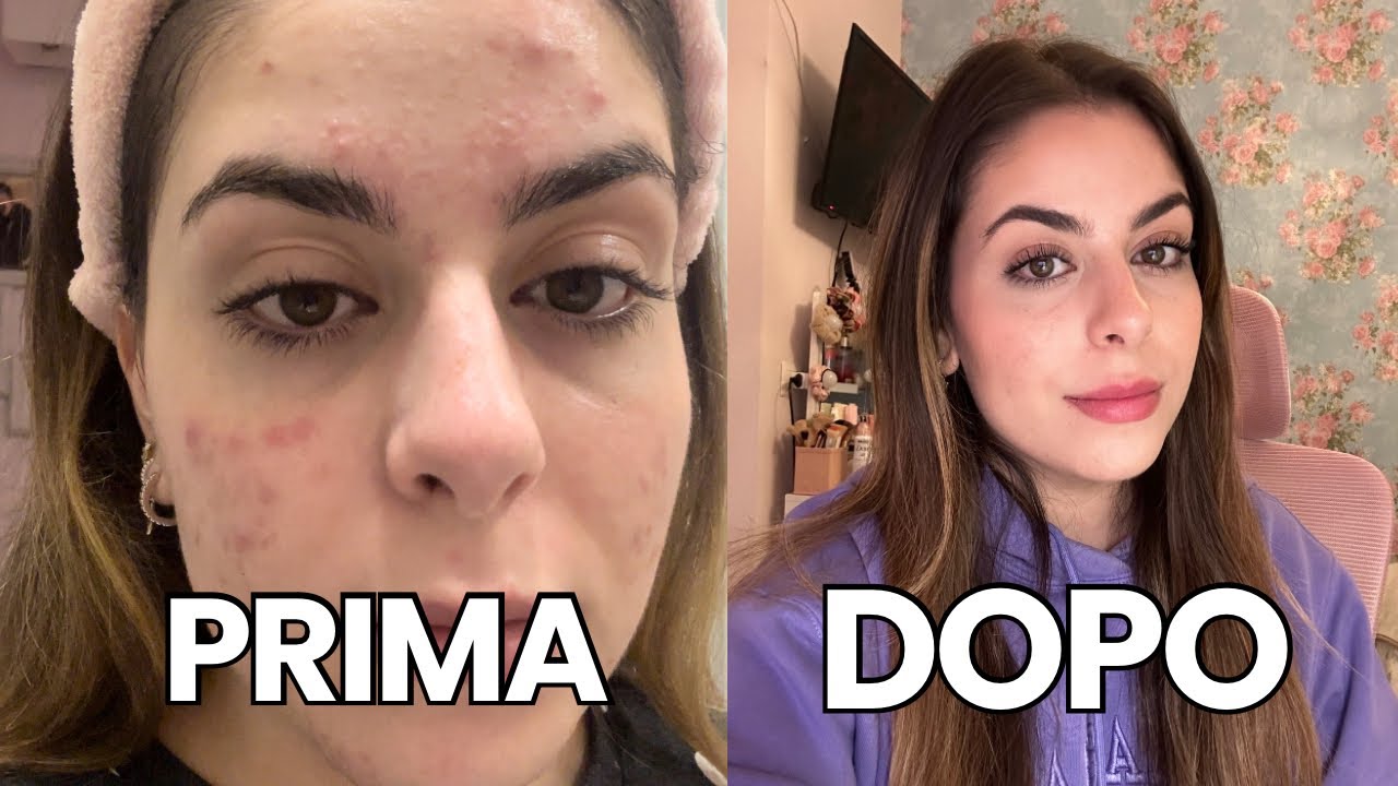 COME HO CURATO L'ACNE- PRODOTTI E STORYTIME