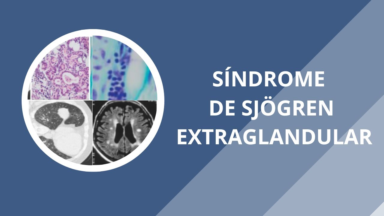 Síndrome de Sjögren Extra glandular