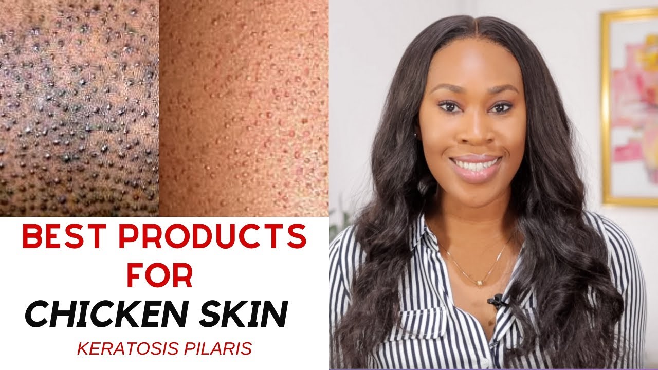 Best products for treating Chicken/Strawberry Skin | How to treat & prevent Keratosis Pilaris .