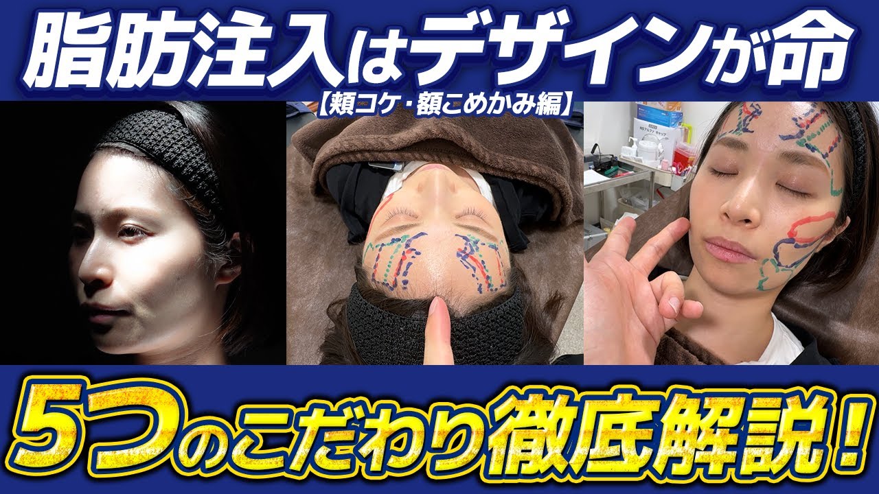 【頬コケ・額こめかみ】脂肪注入はデザインが命！ここに絶対脂肪入れないで！顔が大きくなります。