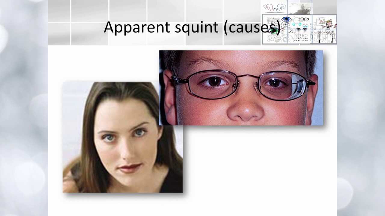 Apparent squint