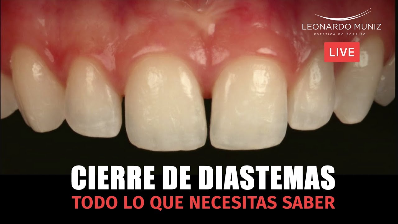 CIERRE DE DIASTEMAS - Todo lo que necesitas saber