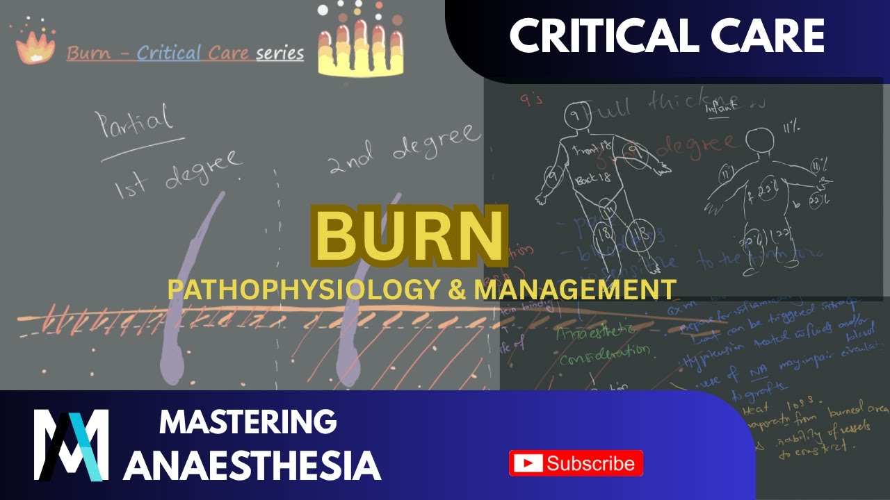 Critical Care Burn Management 🔥: Pathophysiology, Resuscitation & Treatment Basics [EXPLAINED!]