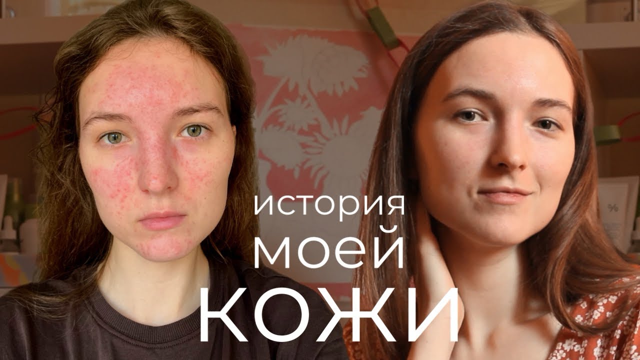 розацеа и акне в 28 лет - что мне помогло? 