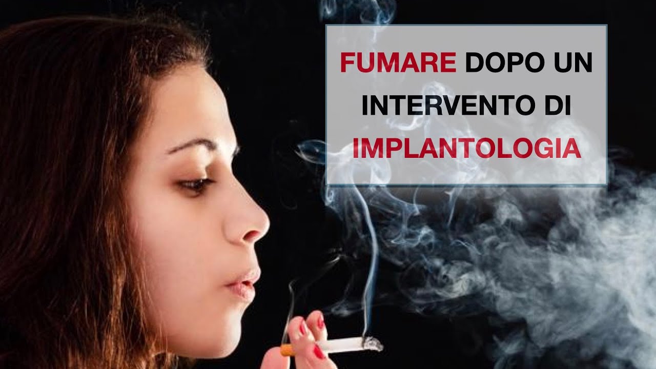 Posso fumare dopo un intervento di implantologia?